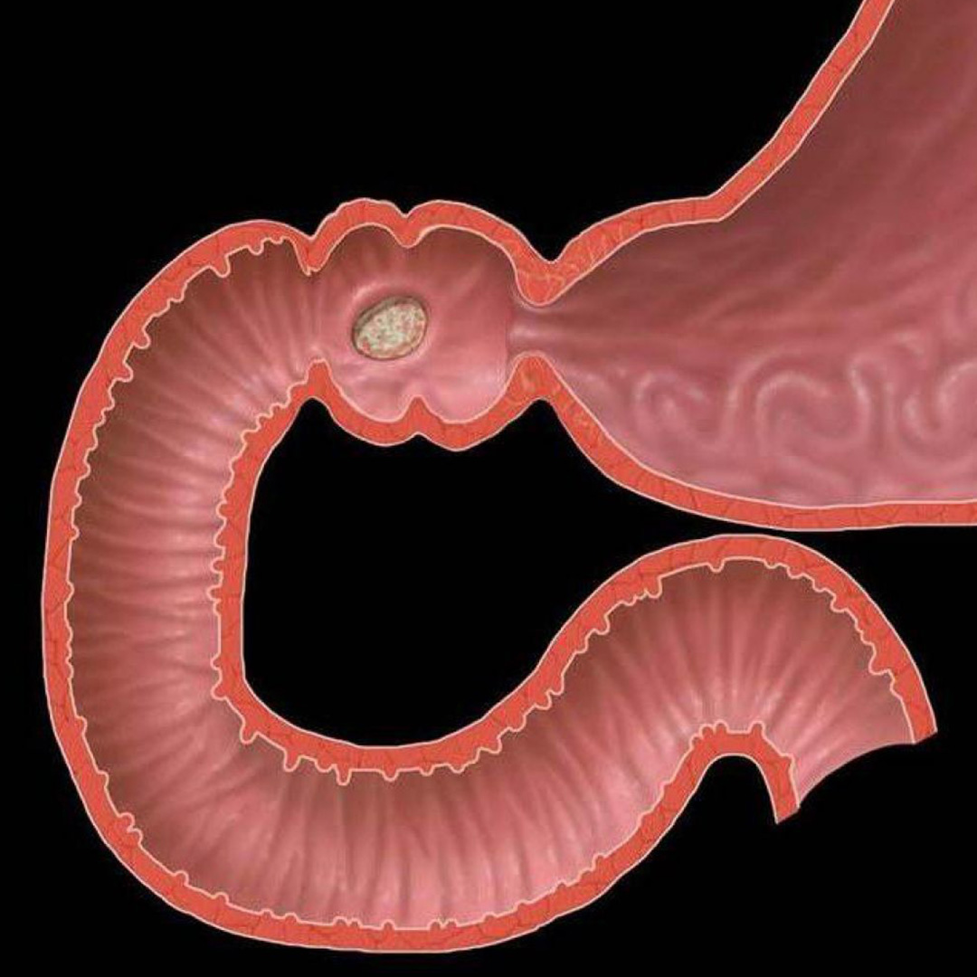 duodenum-oniki-parmak-ba-rsa-lseri-drisiltuzcuoglu